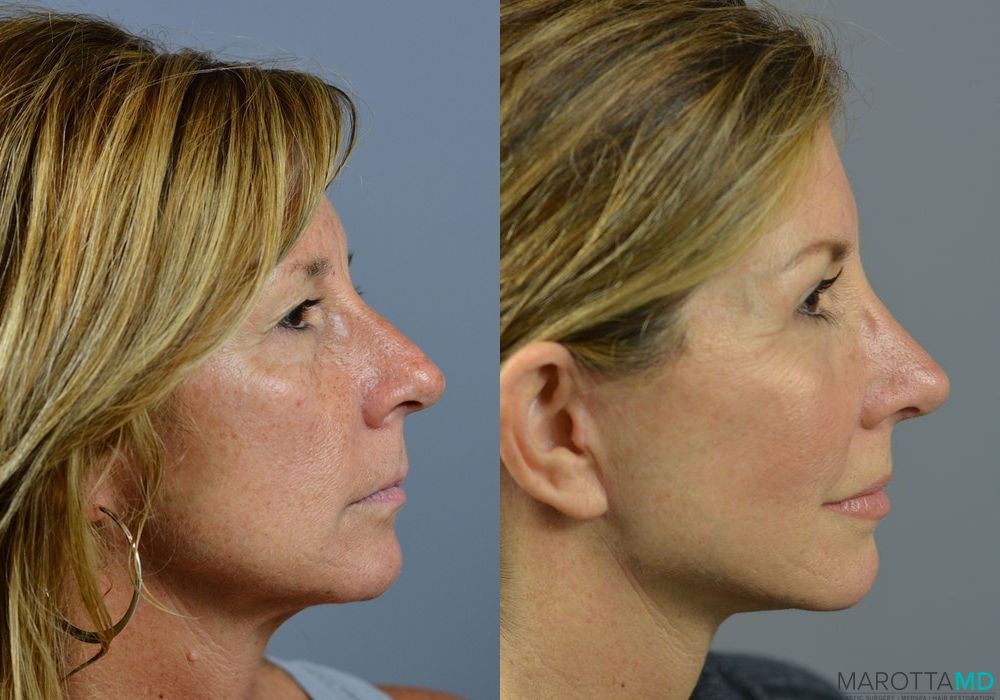 Before and after Fat Transfer - Face case 7255 - Angle 3
