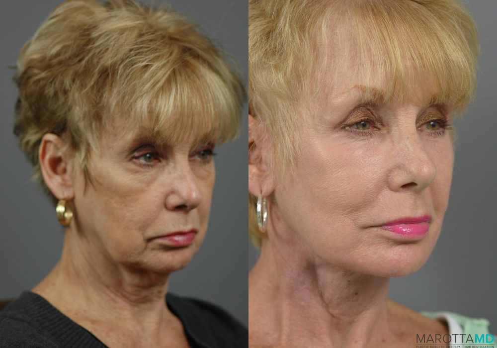 Facelift & Neck Lift - Thumbnail 3