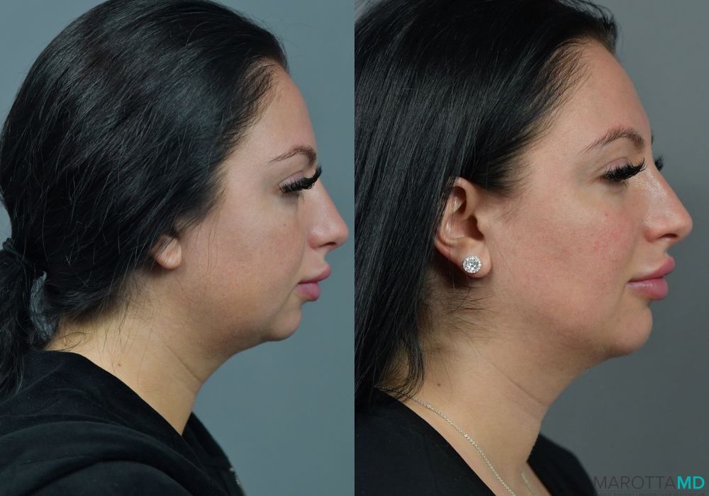 Buccal Fat Removal - Case 175