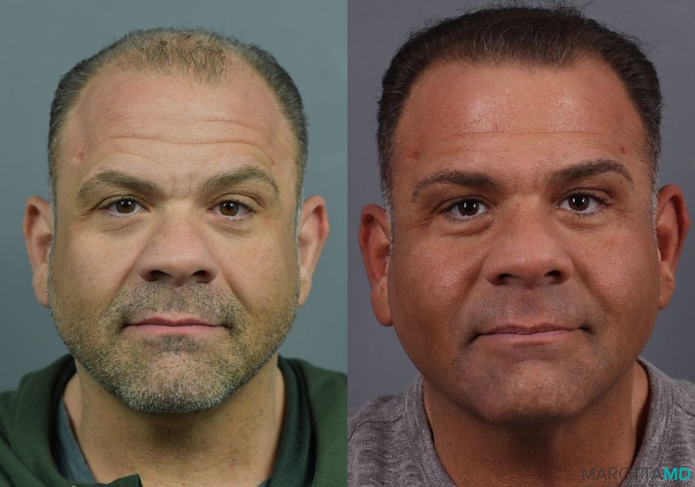 Before and after Hair Growth Serum case 7198