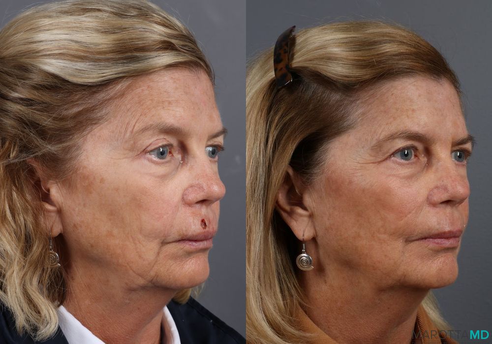 Skin Cancer Reconstruction - Face - Thumbnail 3