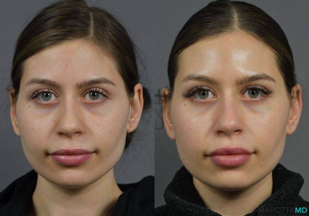 Before and after Botox - Lip Flip case 7289