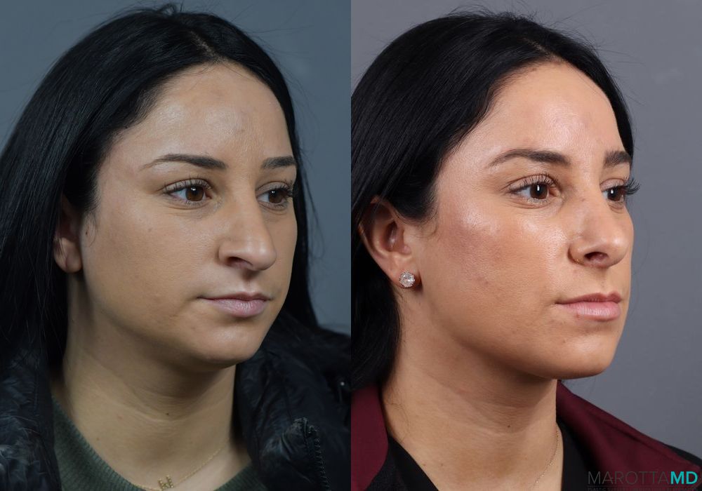 Before and after Rhinoplasty case 7229 - Angle 4