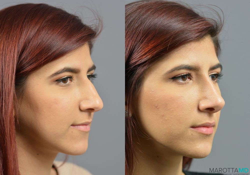 Rhinoplasty - Thumbnail 3