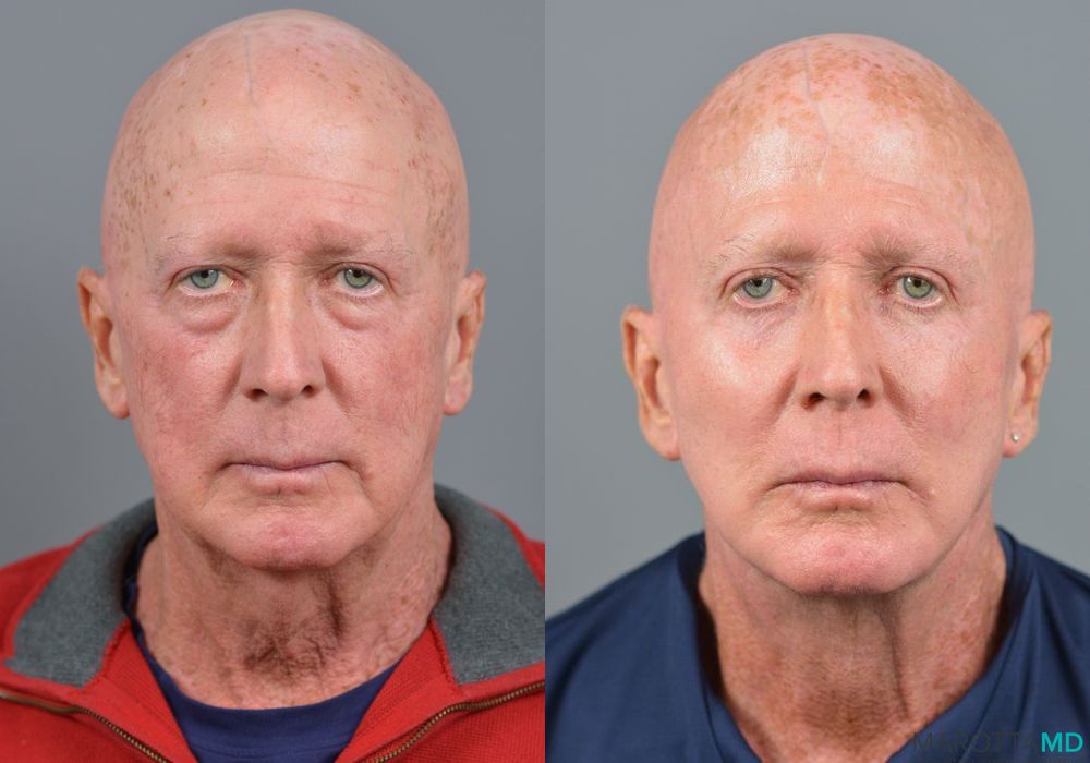 Facelift & Neck Lift - Case 203