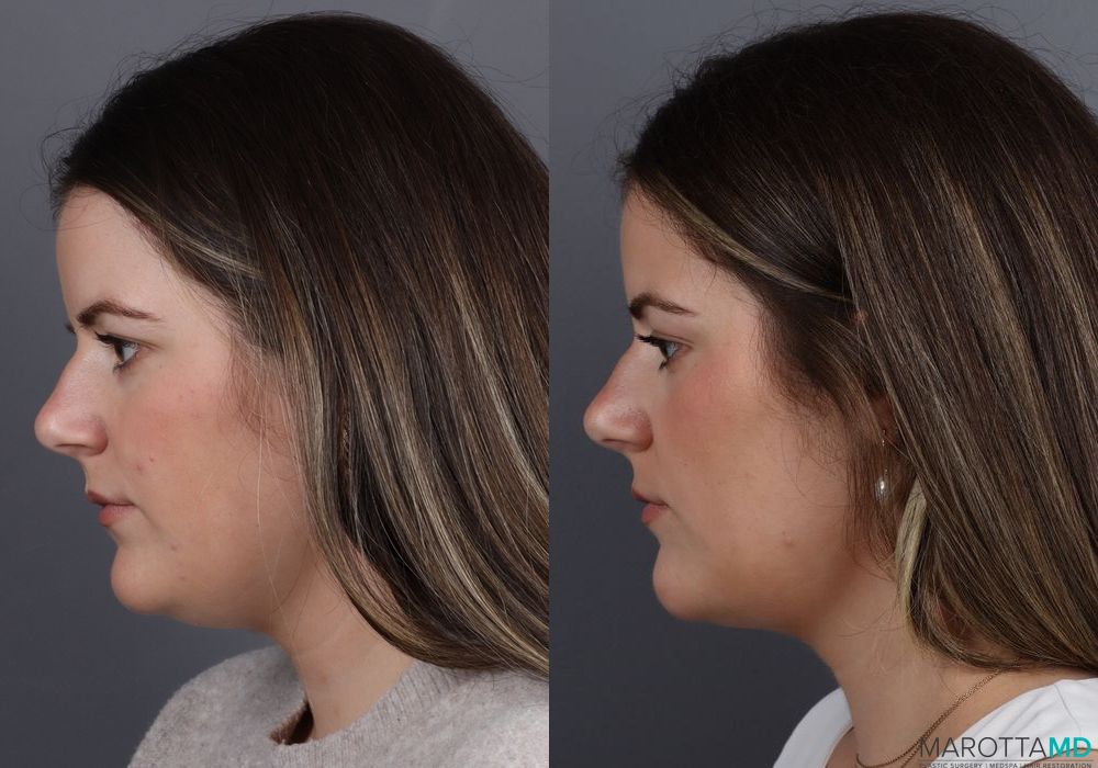 Before and after Skin Tightening Face case 7265 - Angle 5