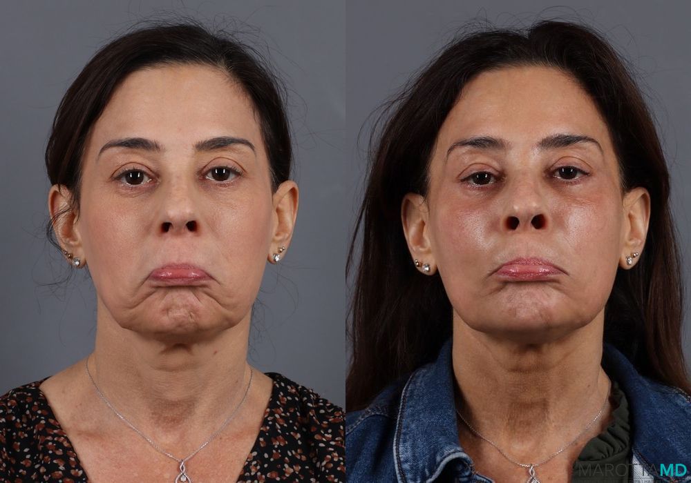 Before and after BOTOX® Cosmetic case 7267 - Angle 2