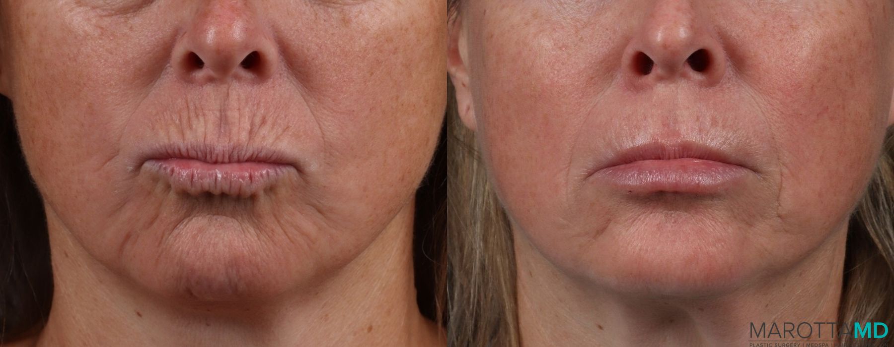 Before and after Botox - Forehead case 7128 - Angle 4