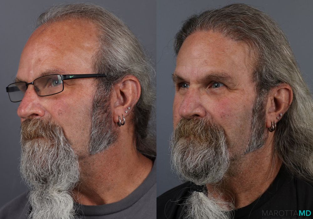 Hair Transplantation - Thumbnail 2