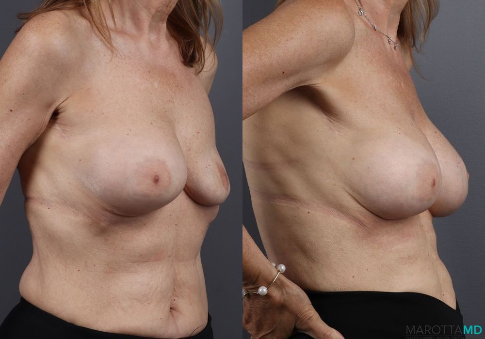 Before and after Breast Implant Exchange case 7245 - Angle 2