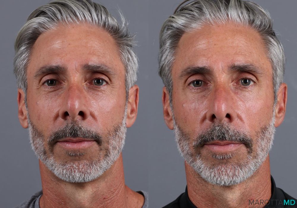 Botox - Crow's Feet - Case 304