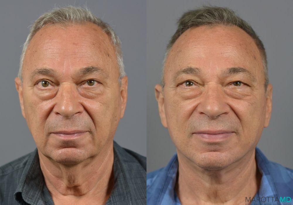 Facelift & Neck Lift - Case 200