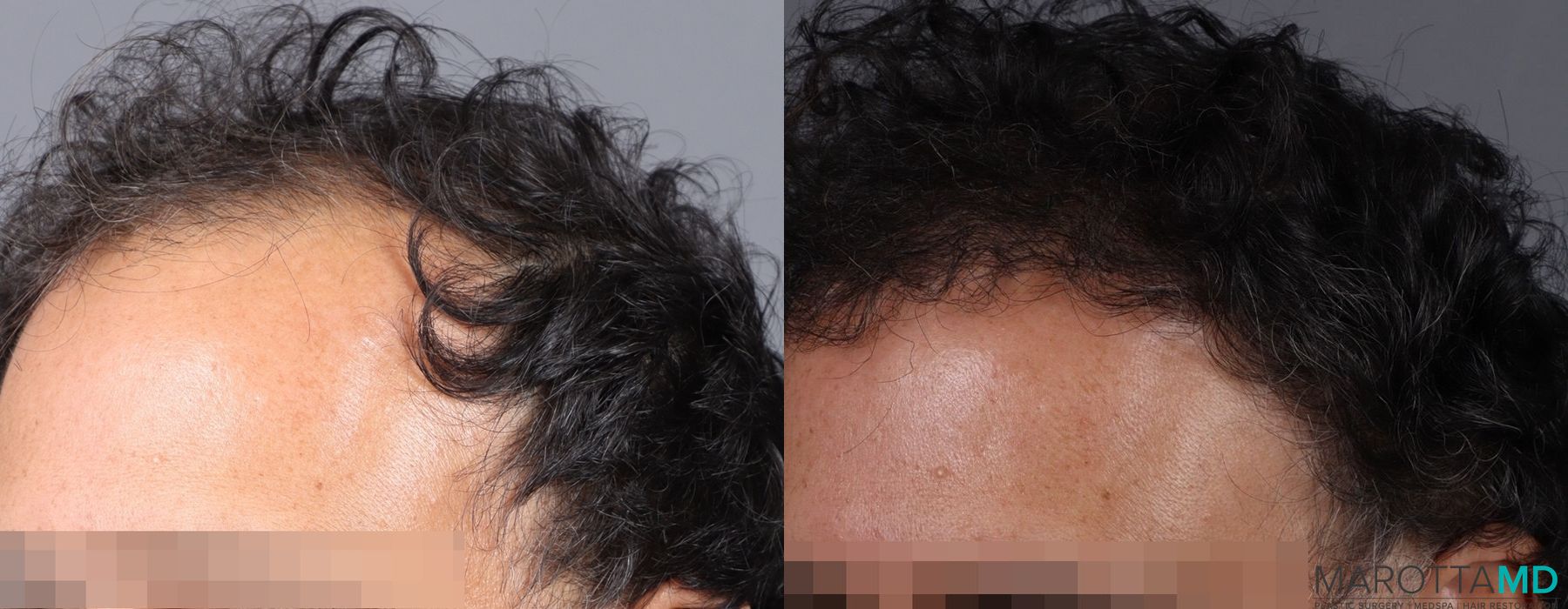 Hair Transplantation - Case 278