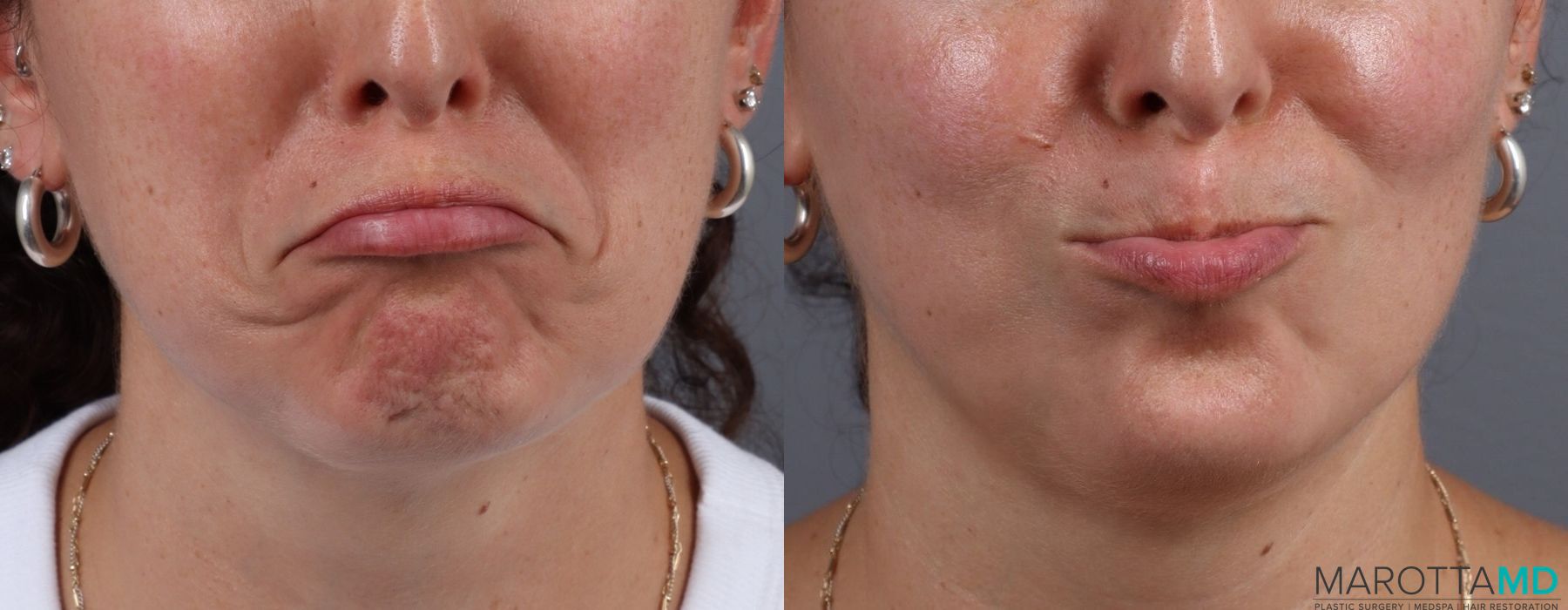 Before and after Botox - DAO case 7196