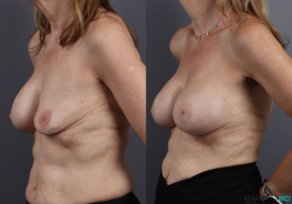 Before and after Breast Implant Exchange case 7245 - Angle 4