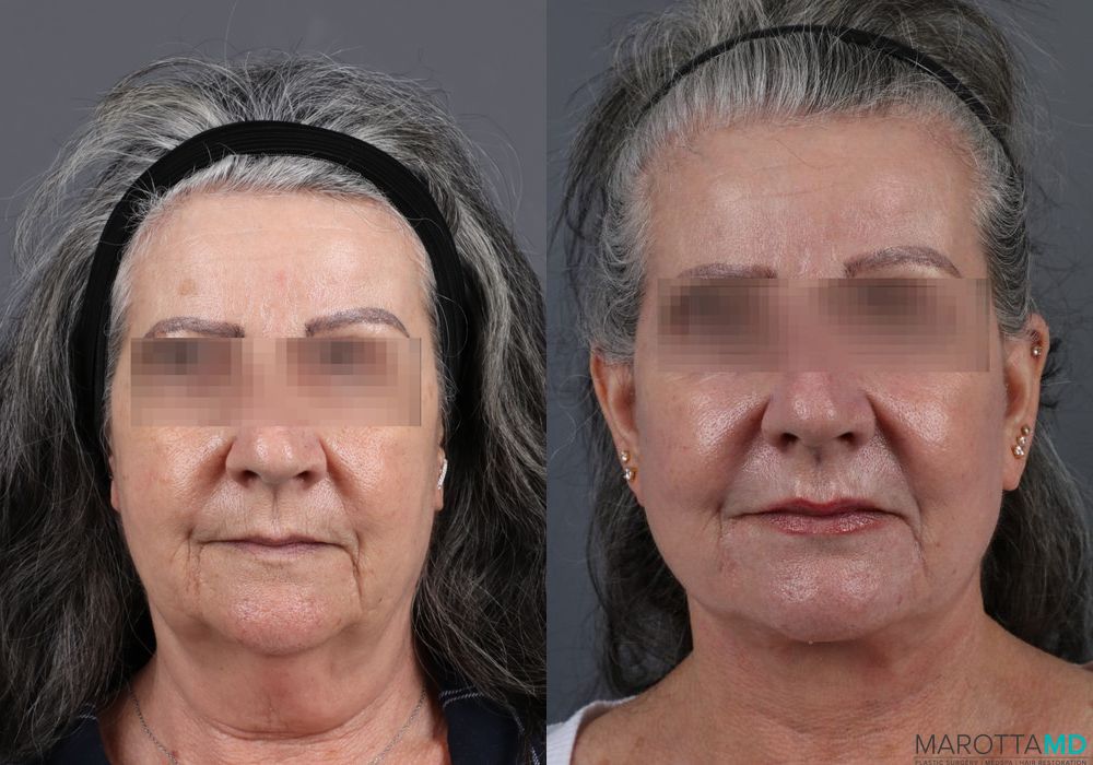 Laser Skin Resurfacing - Face - Thumbnail 2