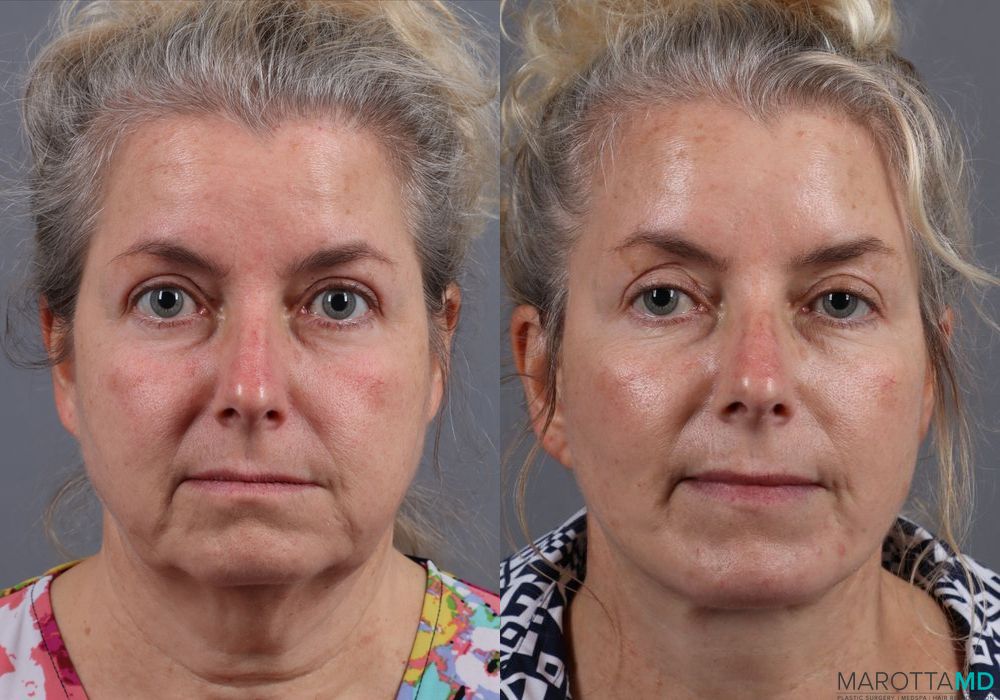 Facelift & Neck Lift - Thumbnail 4