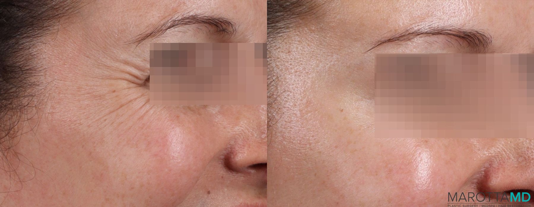 Before and after Botox - Forehead case 7186 - Angle 3