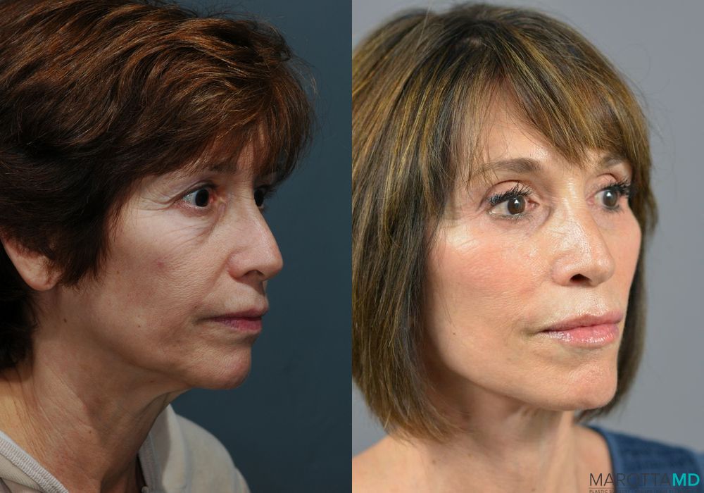 Facelift & Neck Lift - Thumbnail 3