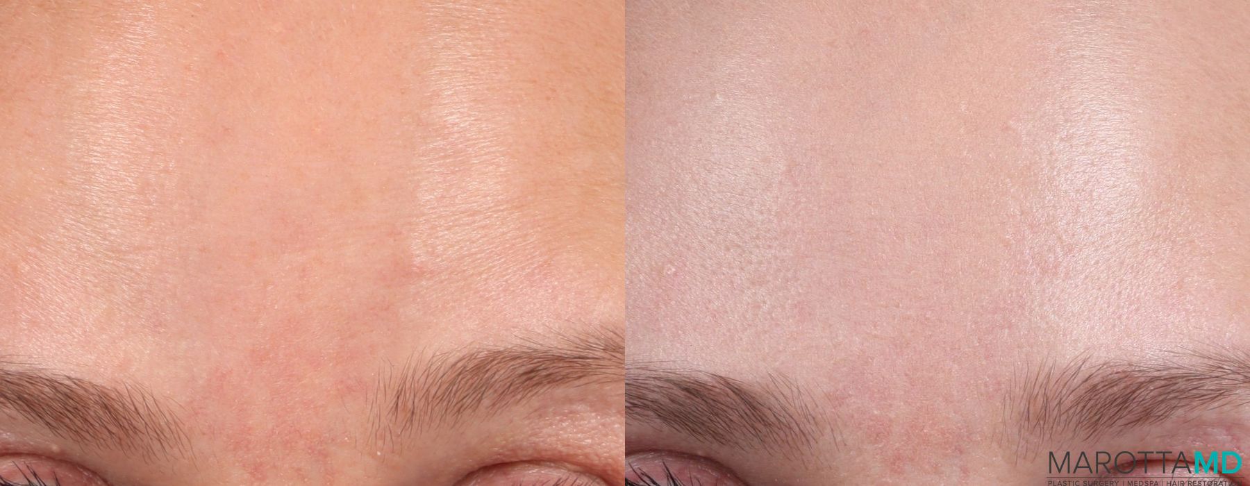 Botox - Crow's Feet - Thumbnail 3