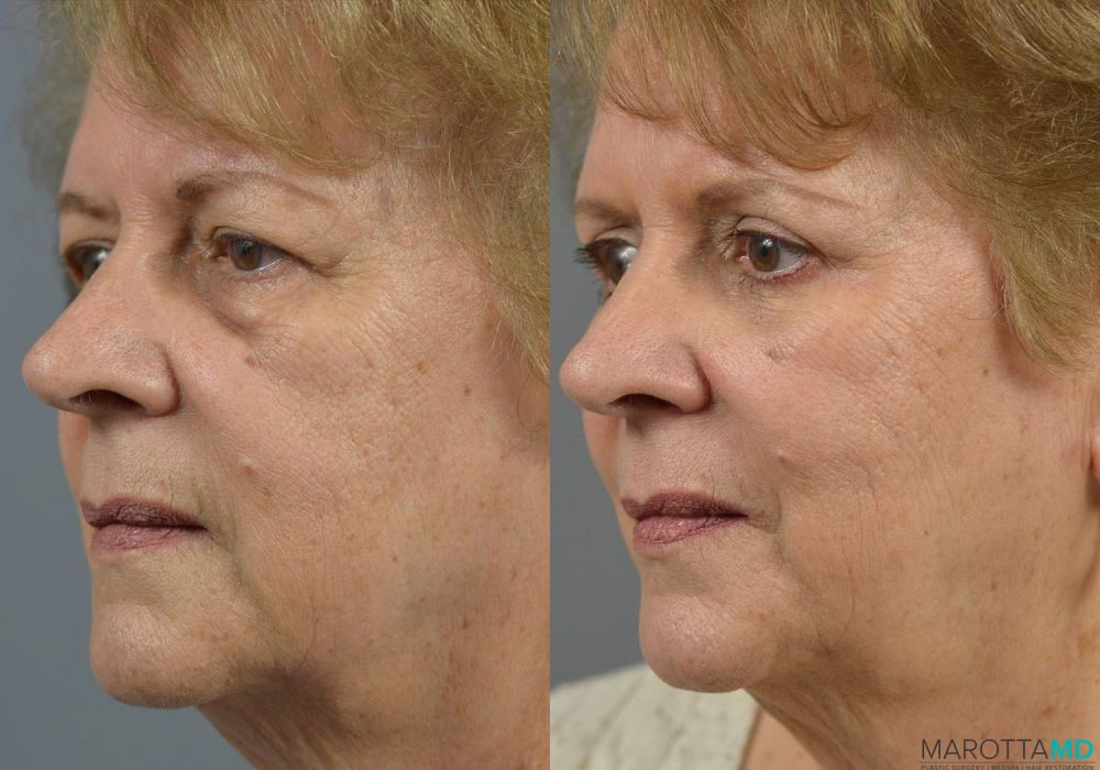 Before and after Blepharoplasty case 7007 - Angle 2