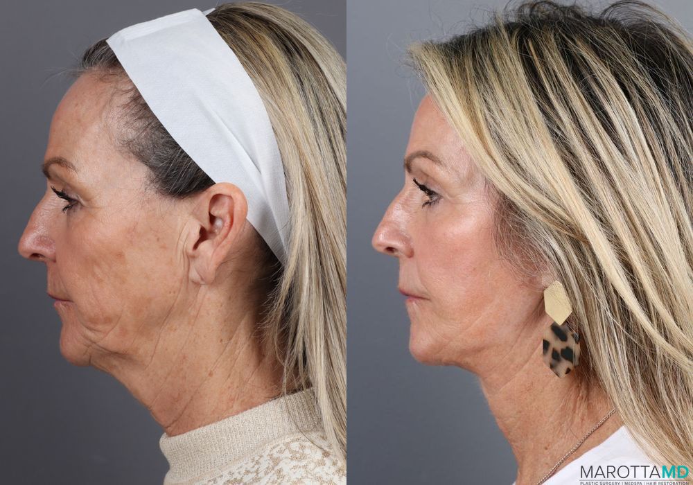 Laser Skin Resurfacing - Face - Thumbnail 3