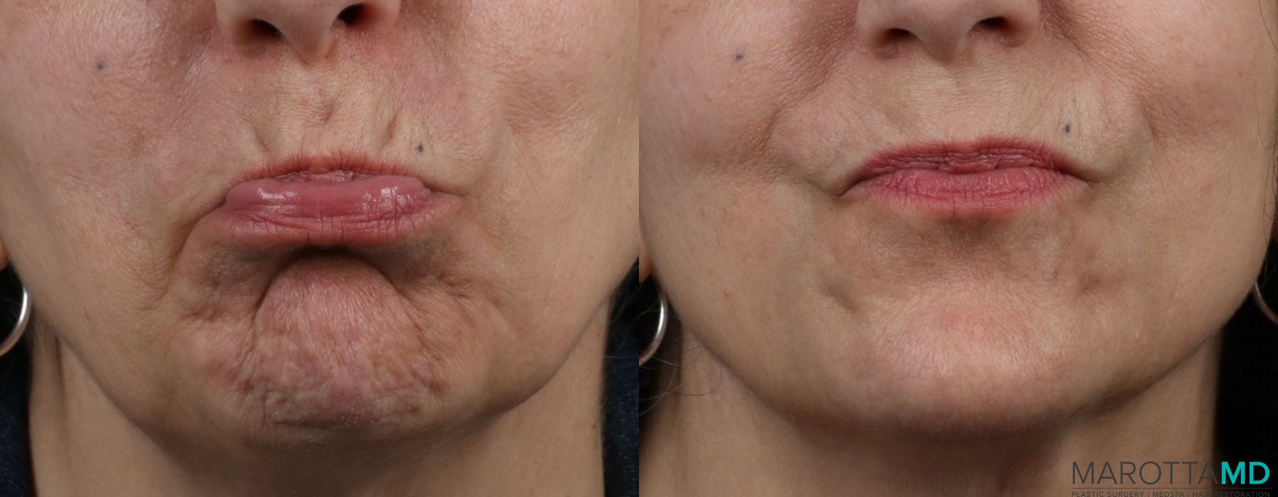 Before and after Botox - Glabella case 7151 - Angle 4