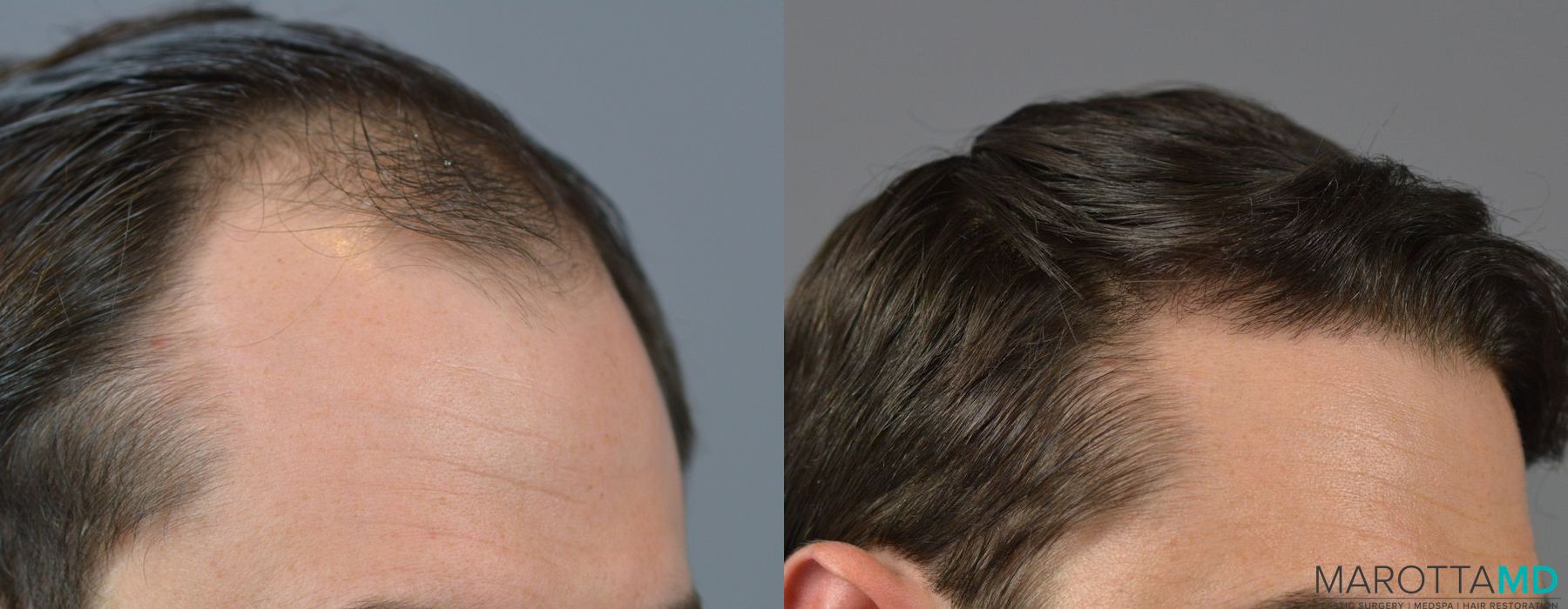 Hair Transplantation - Thumbnail 2