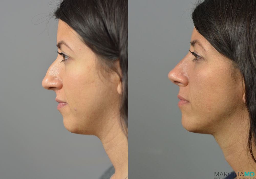 Rhinoplasty - Thumbnail 5