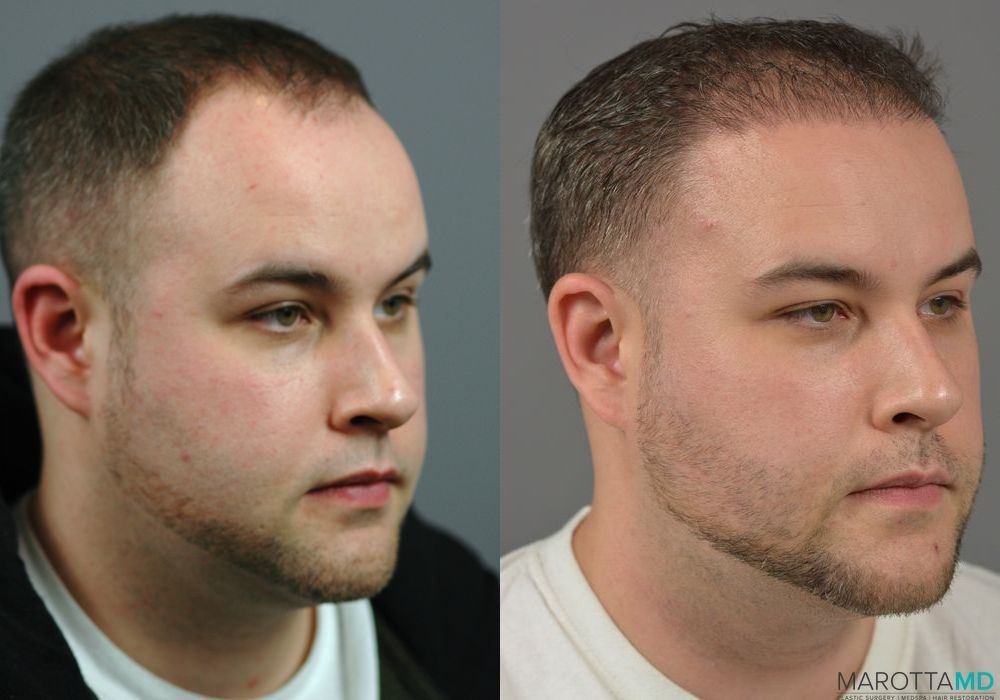 Hair Transplantation - Case 646