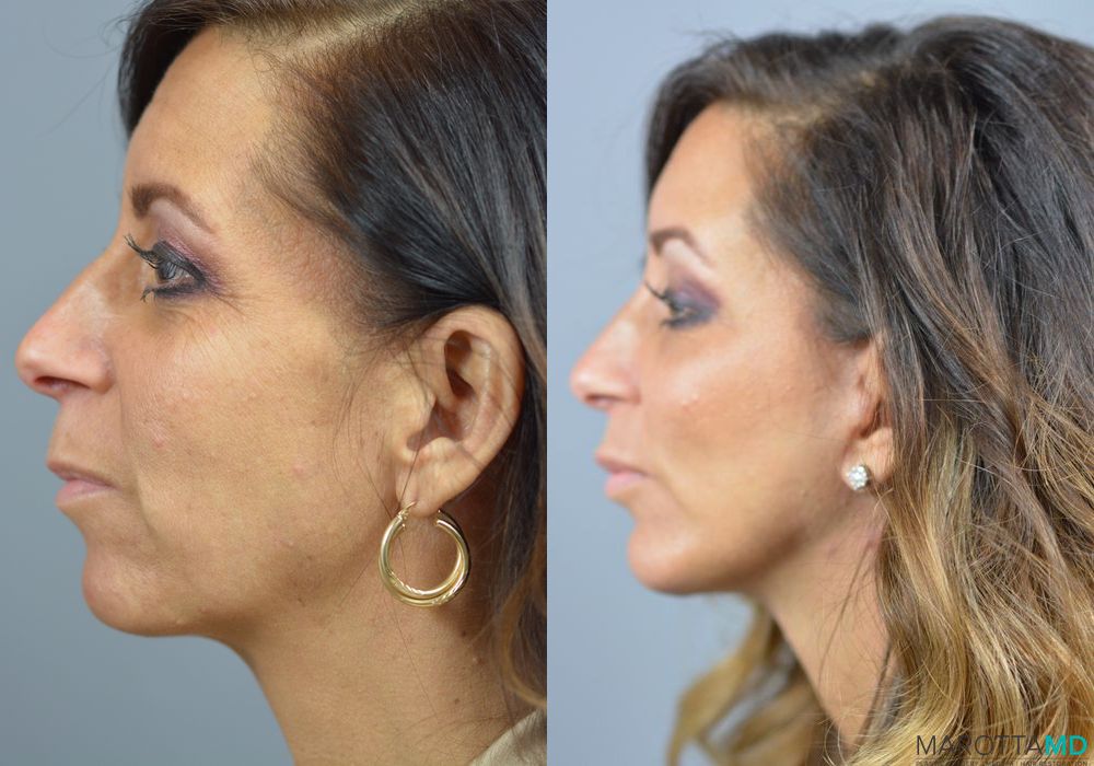 Mini Facelift - Thumbnail 4