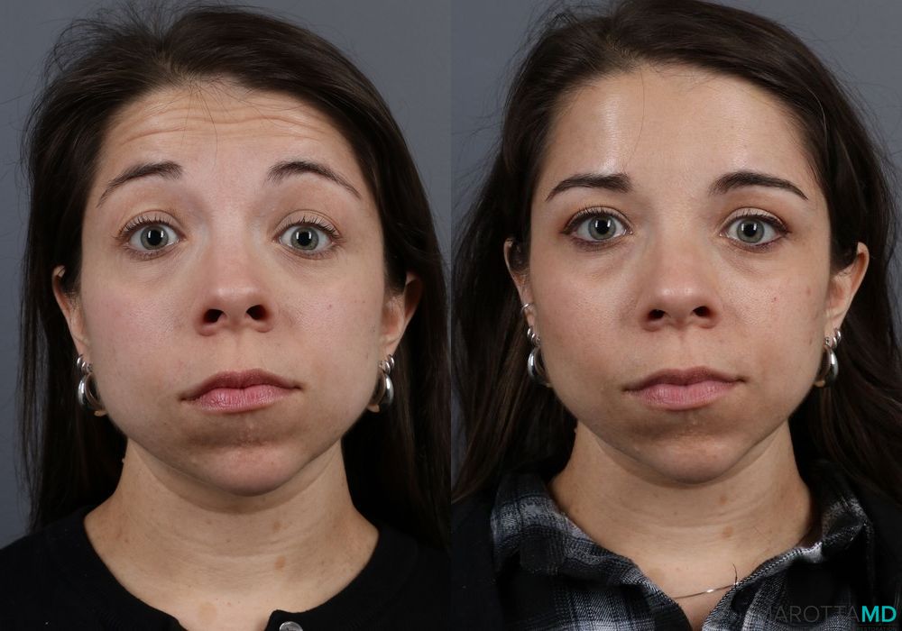 Botox - Forehead - Case 319