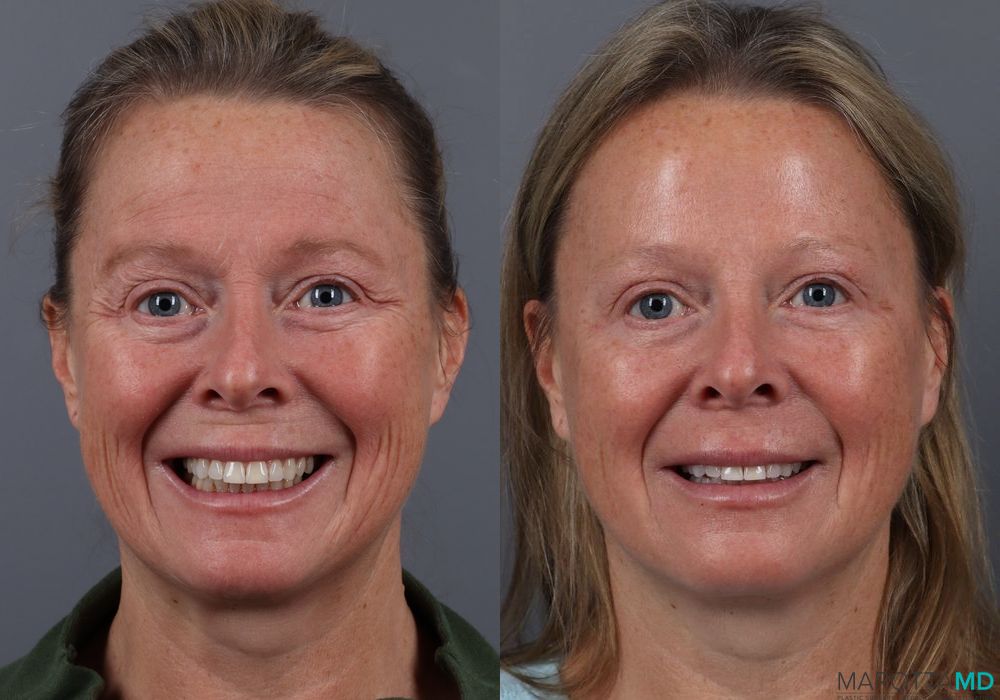 Before and after Botox - DAO case 7132 - Angle 2