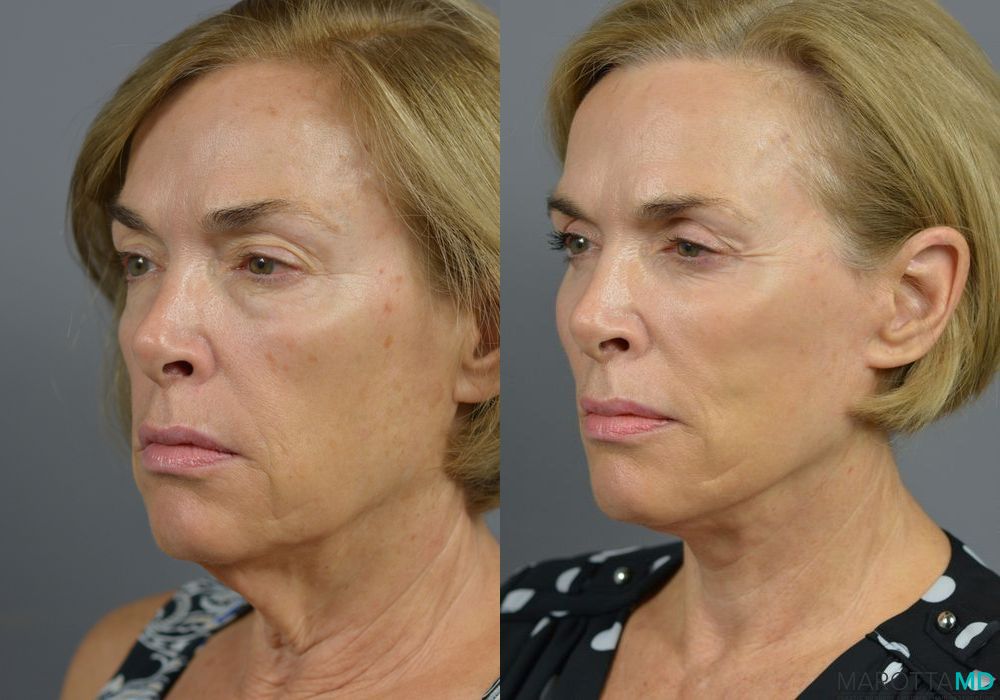 Facelift & Neck Lift - Thumbnail 4