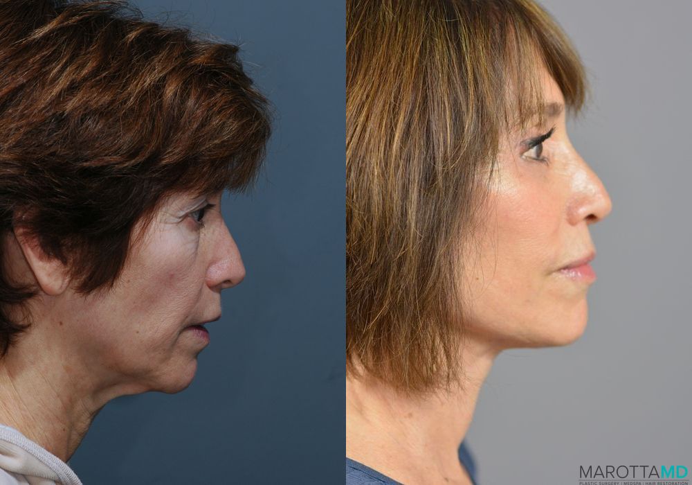 Facelift & Neck Lift - Thumbnail 2