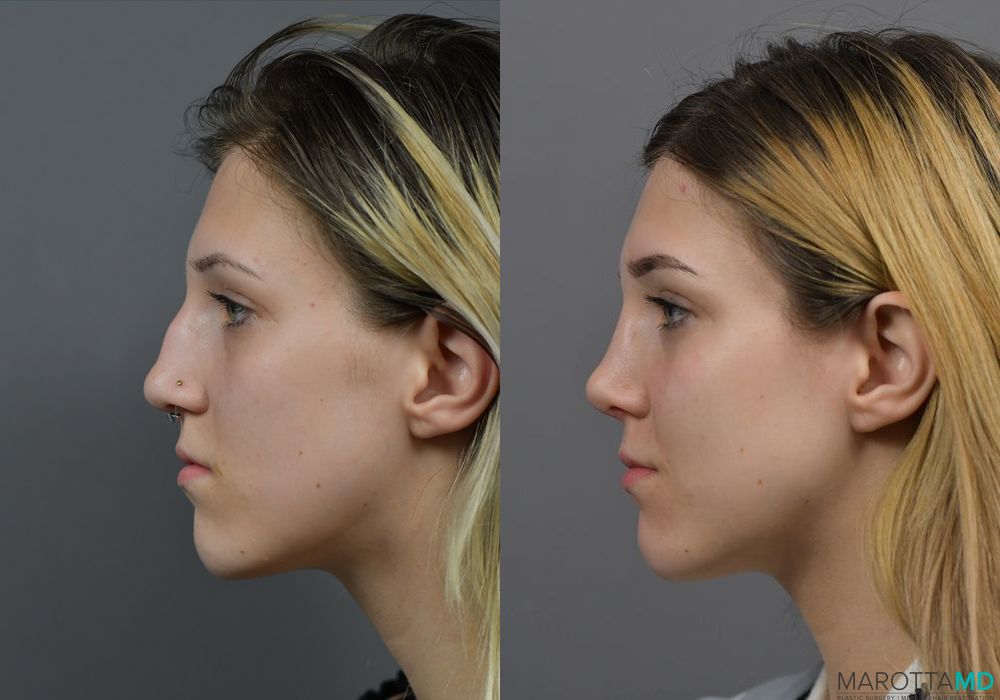 Before and after Rhinoplasty case 7257 - Angle 5