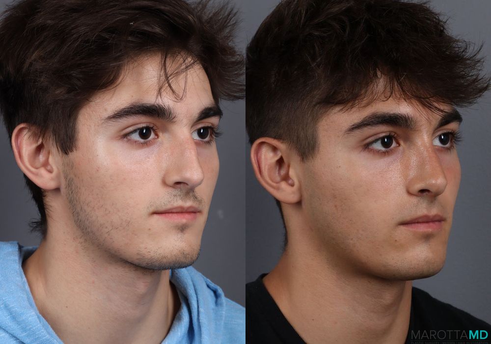 Before and after Male Rhinopolasty case 7015 - Angle 5