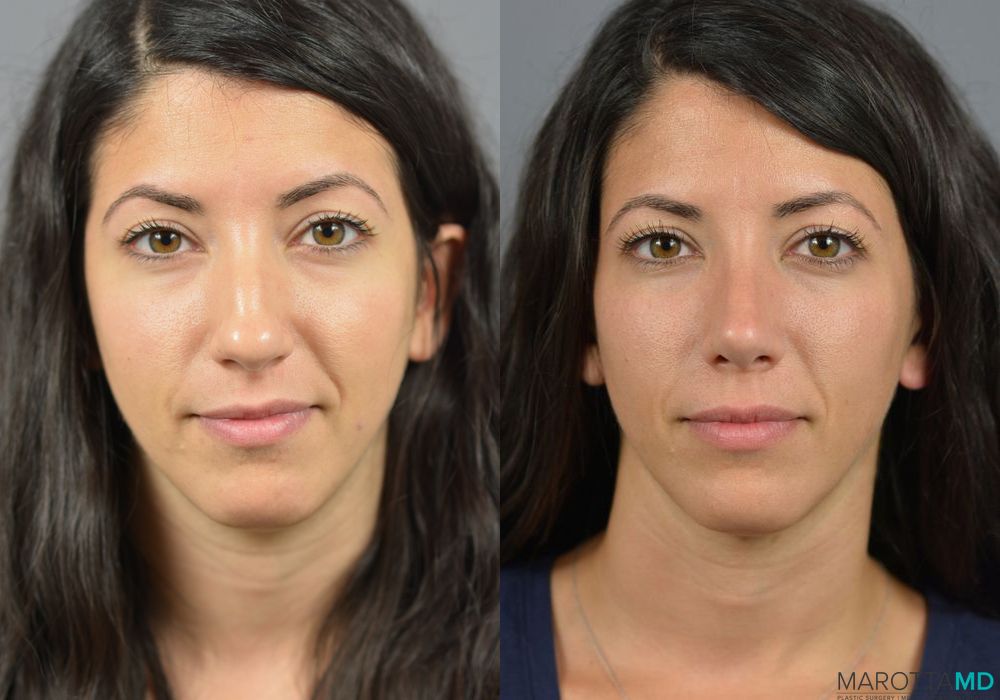 Rhinoplasty - Thumbnail 2