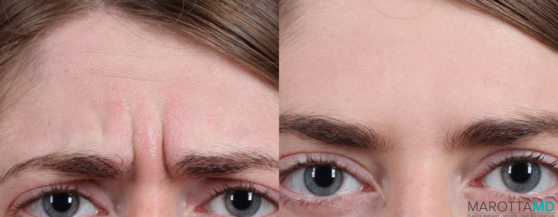 Before and after Botox - Forehead case 7177