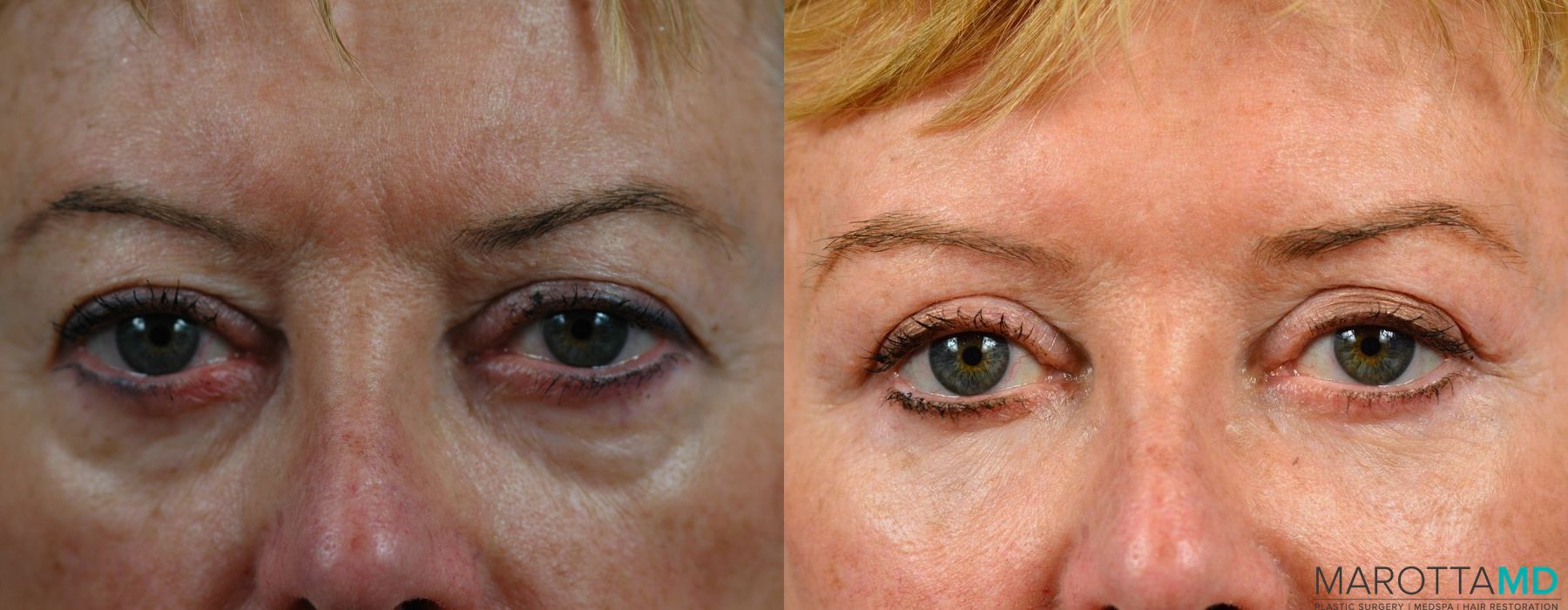 Before and after Fat Transfer - Face case 7227 - Angle 6