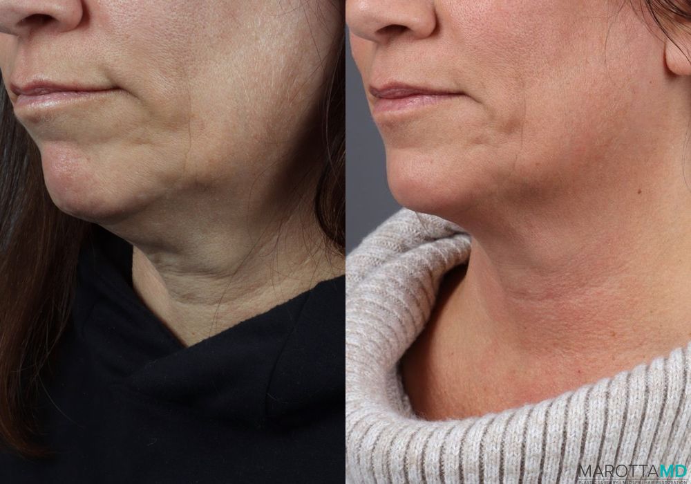 Before and after Genius Radio Frequency Microneedling case 7251