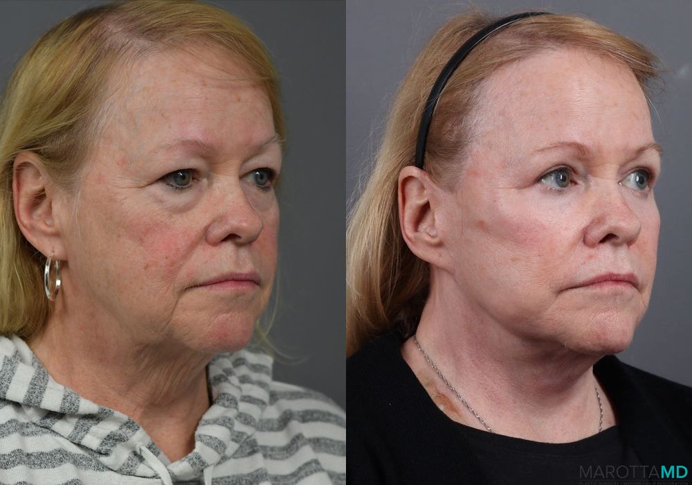 Blepharoplasty - Thumbnail 3