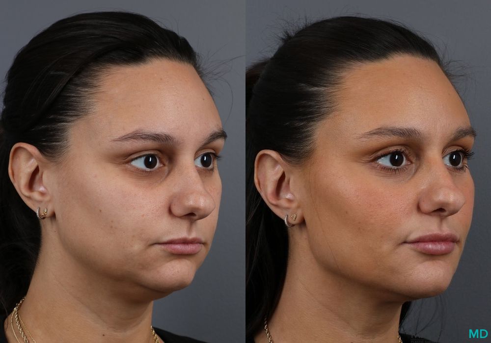 Before and after Filler - Jawline case 7213 - Angle 2