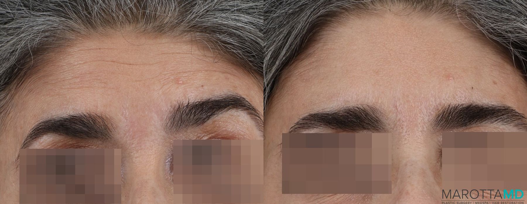 Before and after Botox - Crow's Feet case 7150 - Angle 2