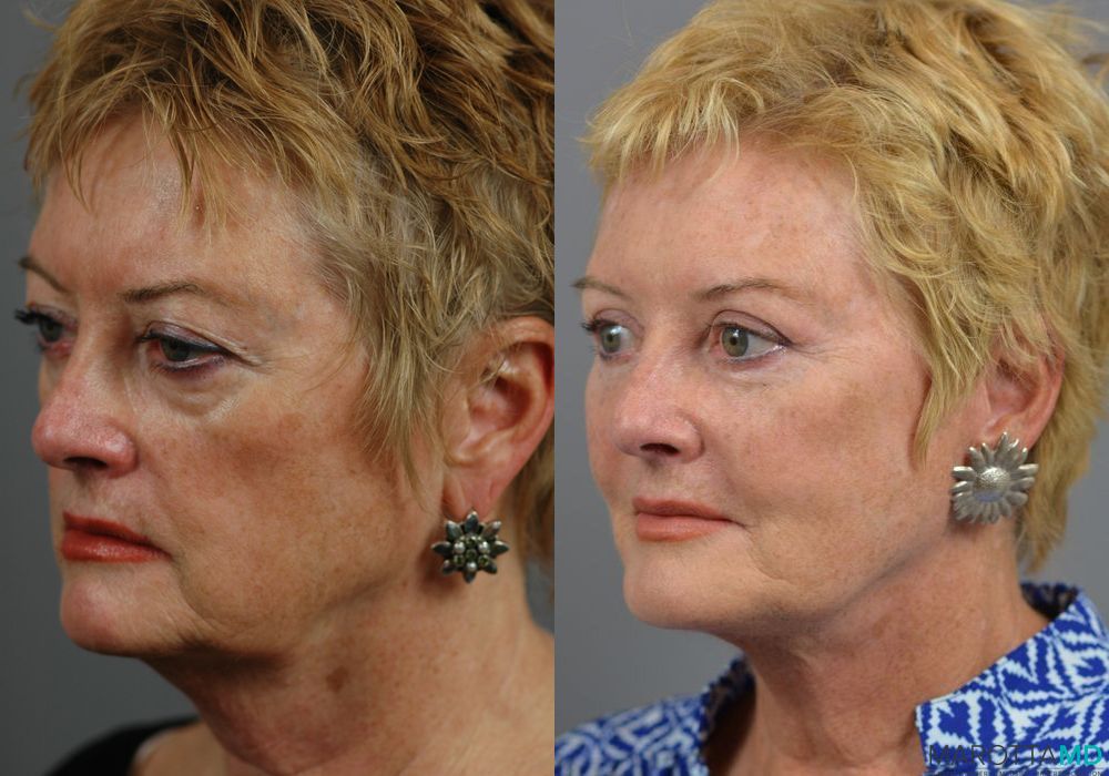 Facelift & Neck Lift - Case 197