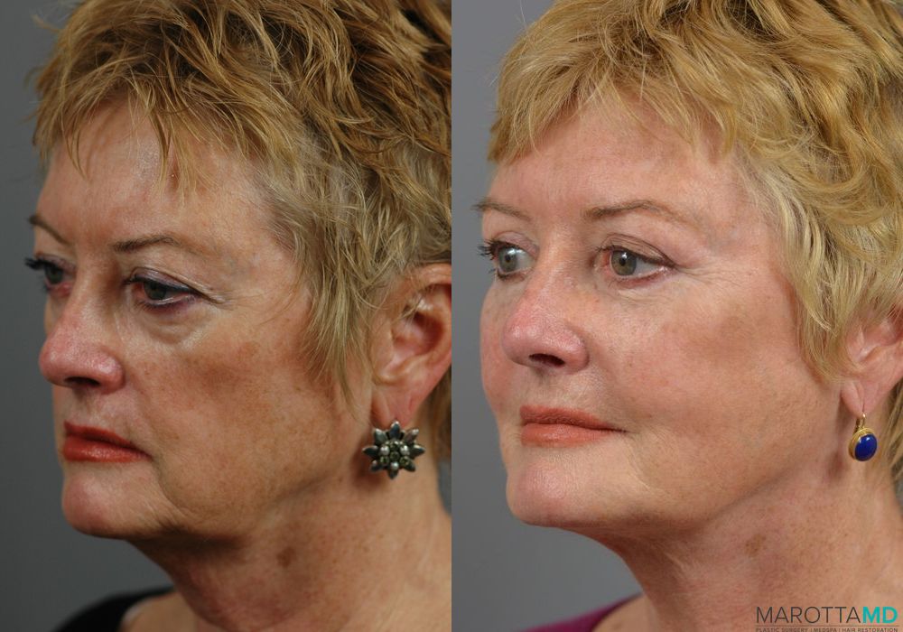 Before and after Fat Transfer - Face case 7227 - Angle 3