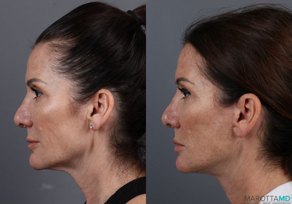 Facelift & Neck Lift - Thumbnail 3