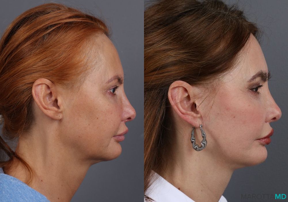 Hair Transplantation - Thumbnail 4