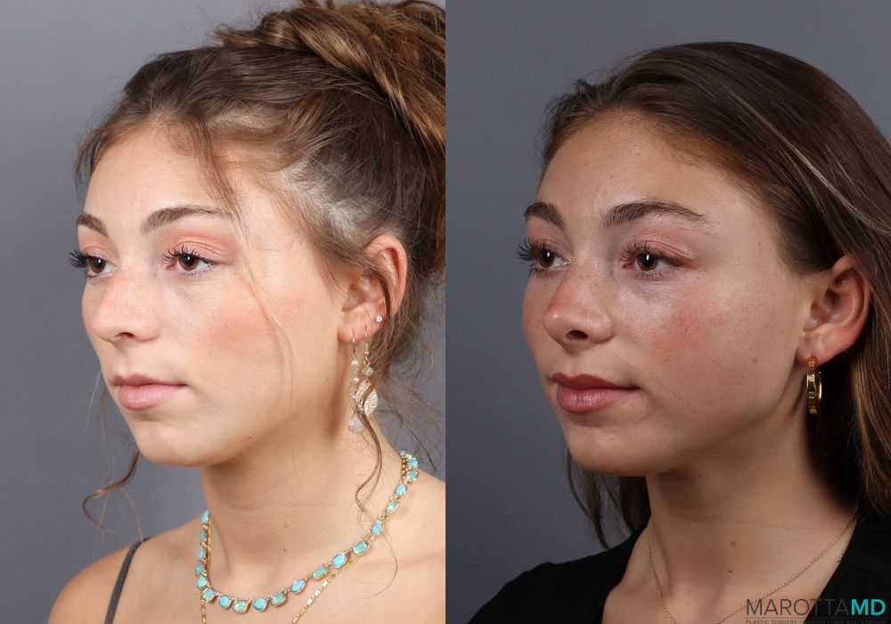 Before and after Rhinoplasty case 7264 - Angle 2