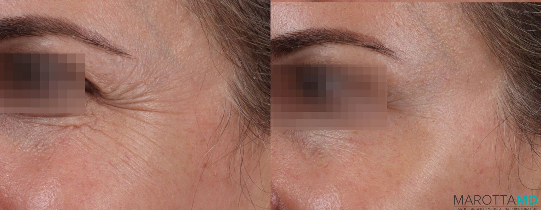 Before and after Botox - Crow's Feet case 7160 - Angle 2